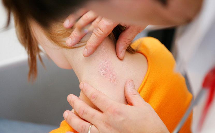 Psoriasis in Children 